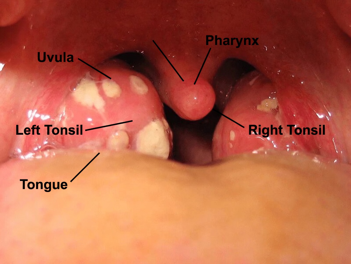 What Are Those White Bumps in Your Mouth and Could They Be Related to Common Daily Habits