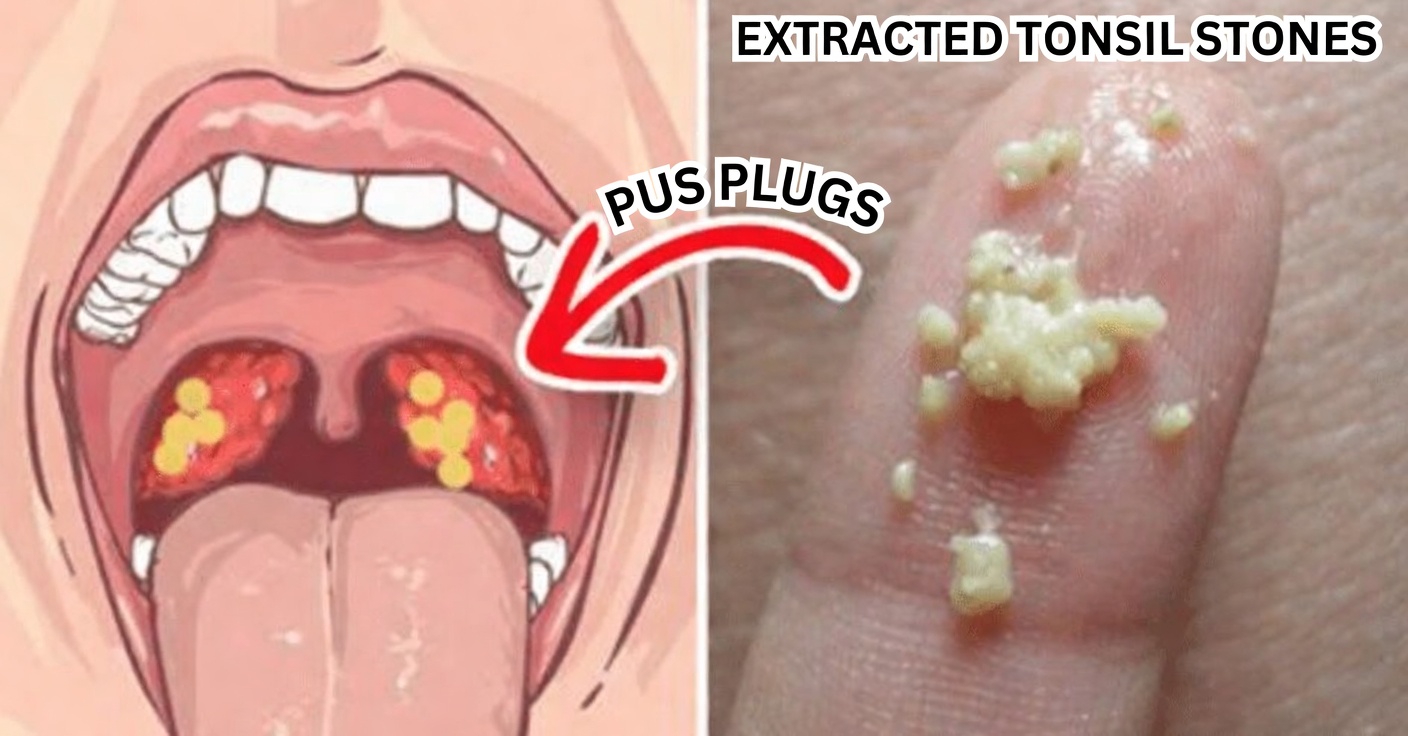 What Are Those White Bumps in Your Mouth and Could They Be Related to Common Daily Habits