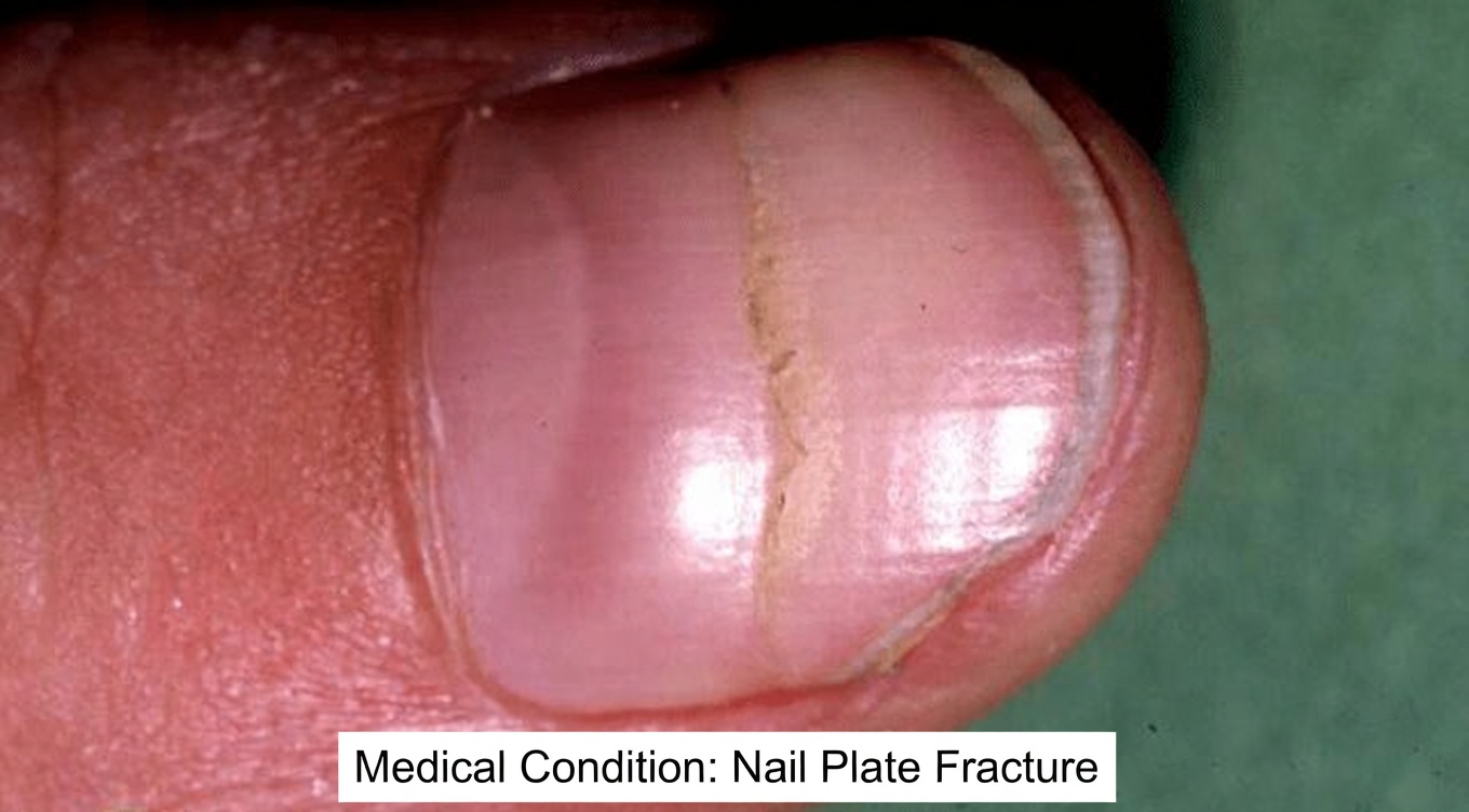 What Do Those Ridges on Your Nails Really Mean? Simple Daily Habits to Support Healthier Nails