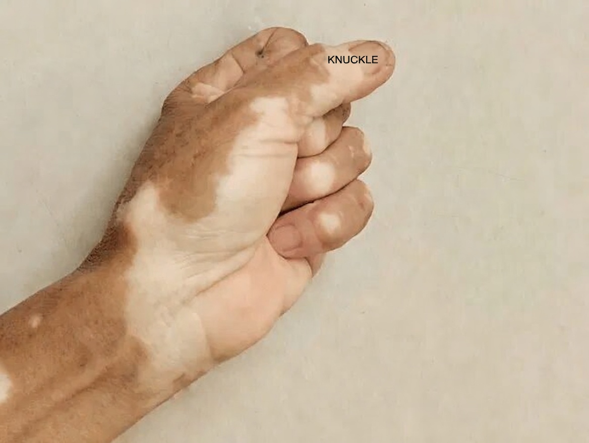 Why Do White Spots Appear on Your Arms and Legs? Understanding Common Causes and Skin Care Tips