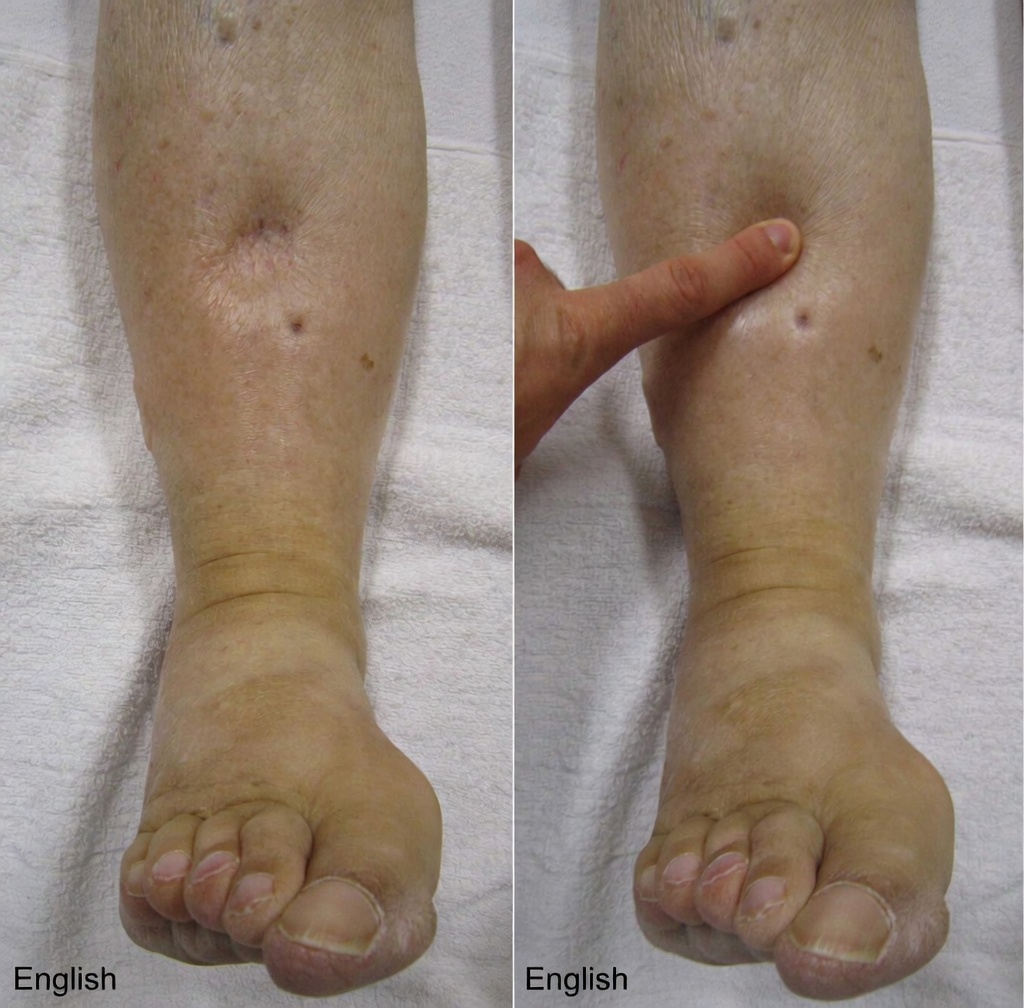 What Are the 12 Most Common Amlodipine Side Effects and Everyday Habits That Can Make a Difference?