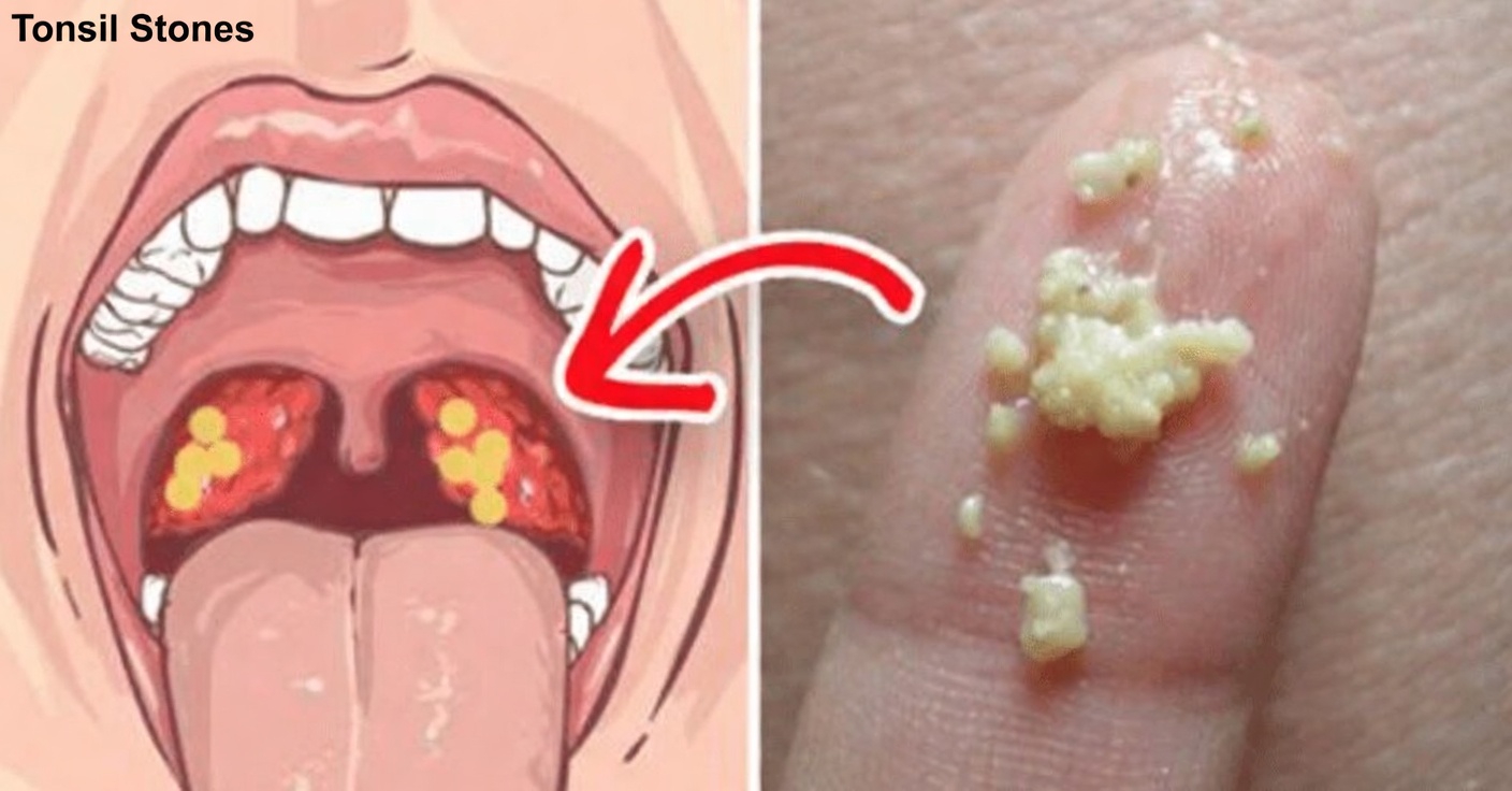 What Are Those White Bumps in Your Mouth and Could They Be Related to Common Daily Habits