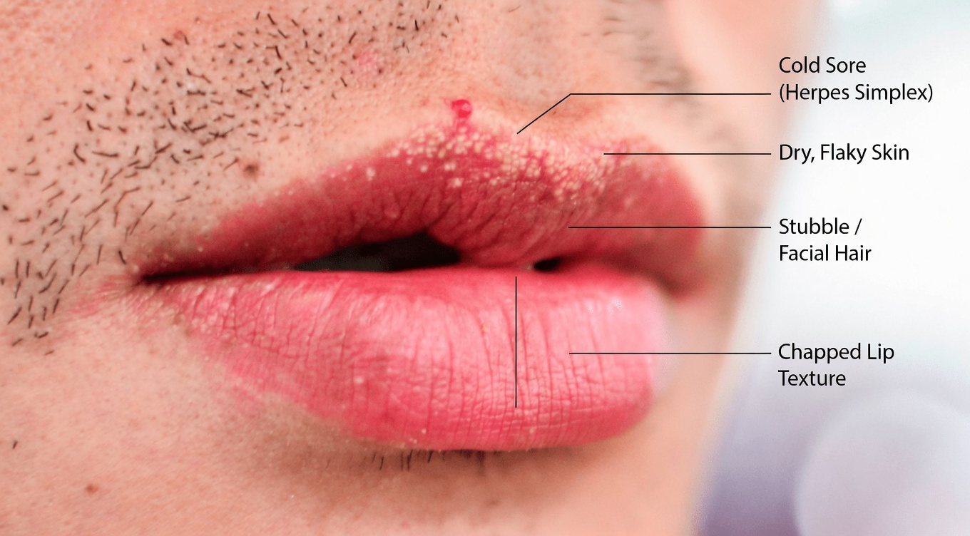 Why Do People Get Unusual Small White Bumps on Their Lips or Private Parts? A Simple Guide