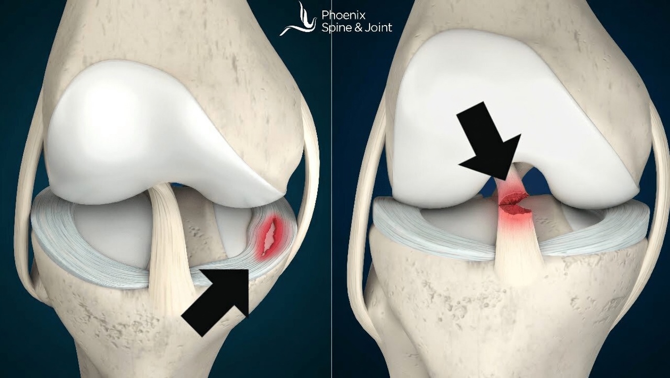 What Happens to Your Knee When the Cruciate Ligament Tears? Signs, Causes, and What Comes Next