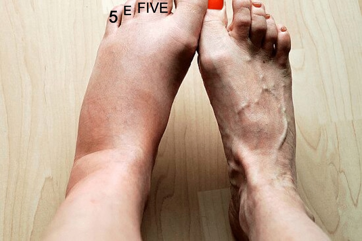 What Swollen Legs Might Reveal About Your Health – And Why It Matters