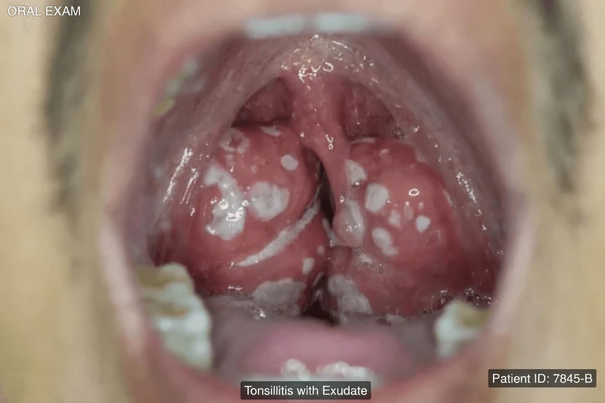 Tonsil Stones: What They Are, Why They Happen and Simple Daily Habits to Manage Them