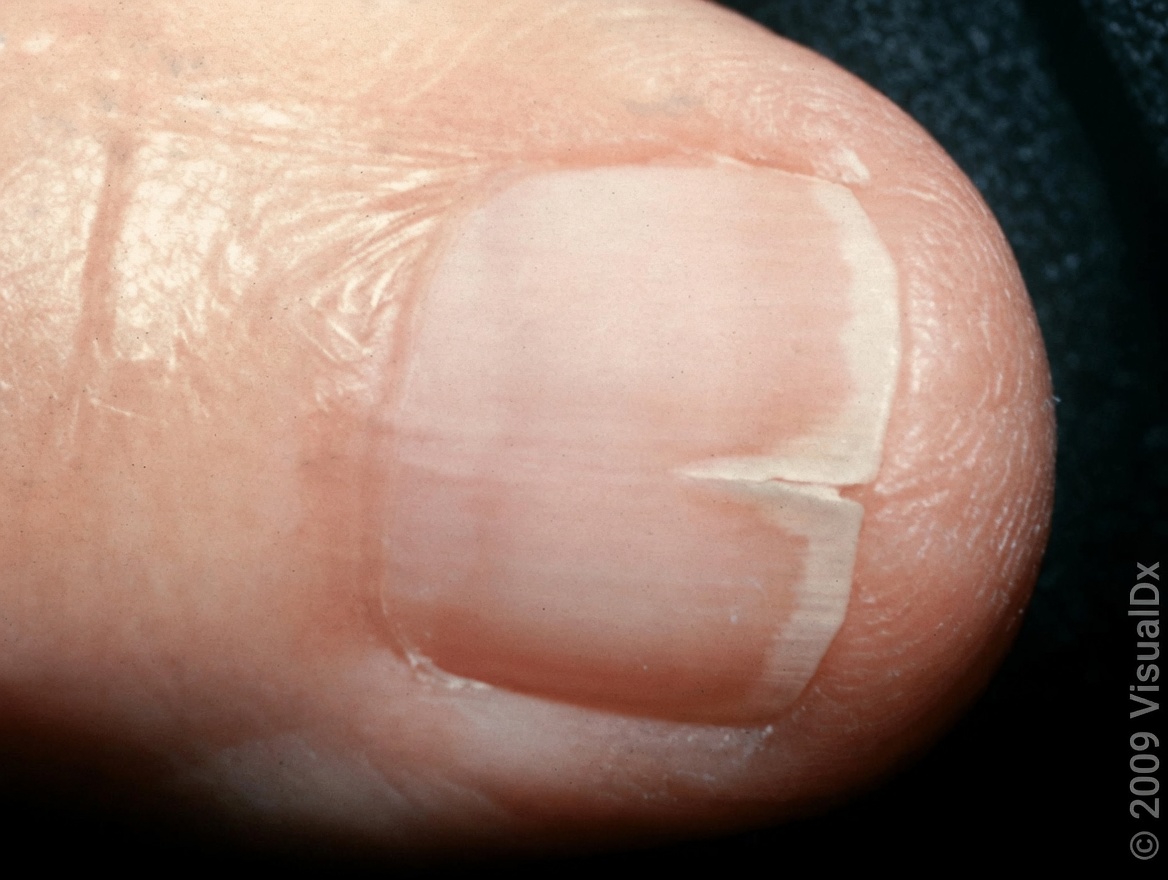 Are Your Nails Always Splitting or Breaking? Here’s What Your Body Might Be Trying to Tell You