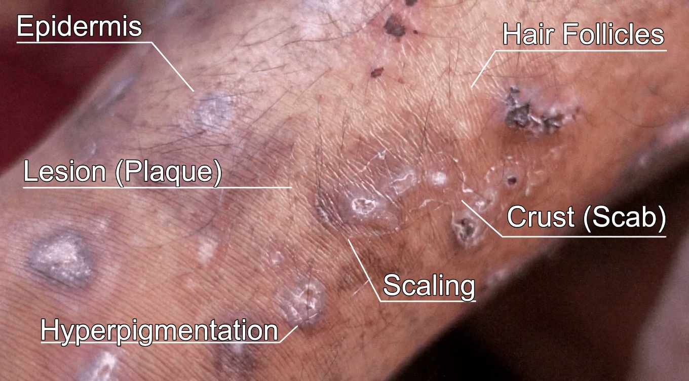 12 Signs of Liver Cirrhosis You Should Know About to Support Your Liver Health Awareness