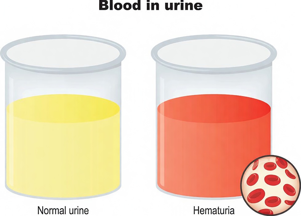 6 Signs of Kidney Disease That Can Show Up in Your Day-to-Day Life and Why They Matter