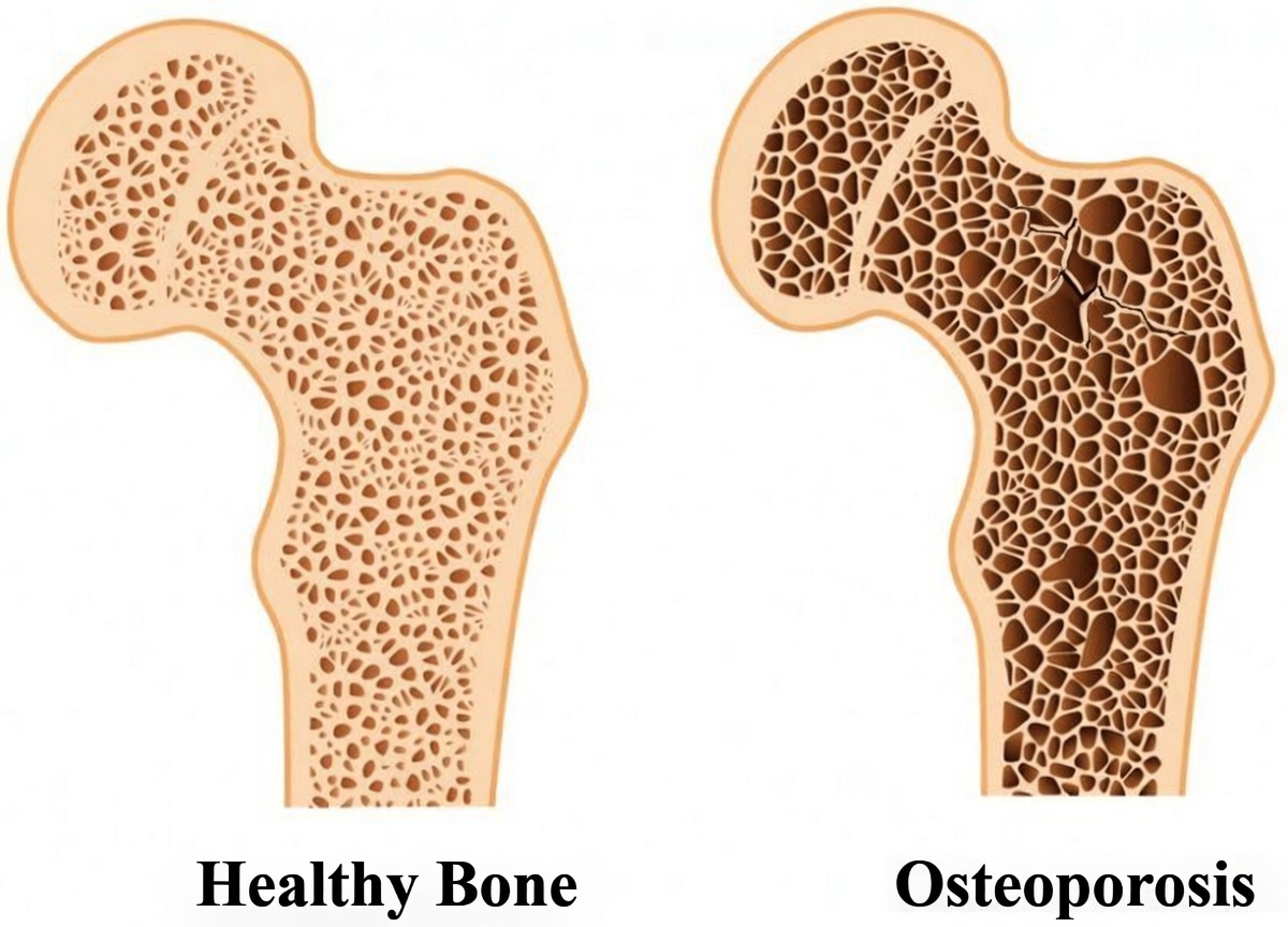 Are You Taking Prilosec Daily? Here Are 5 Key Facts About Long-Term Use Everyone Needs to Know