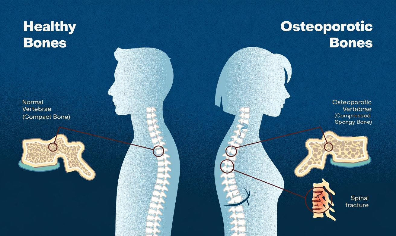Healthy Spine vs Osteoporosis: Simple Daily Habits to Support Strong Bones and Better Posture