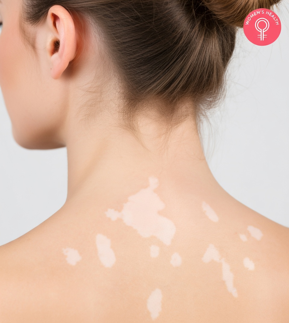 Have You Noticed Small White Spots on Your Arms or Legs? Common Causes and Everyday Insights