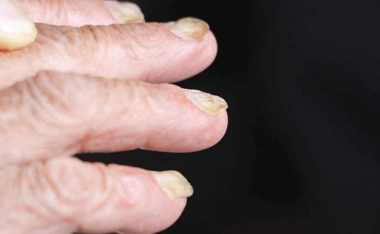 Are You Noticing These 5 Nail Changes That Could Be Important Signals for Your Health?