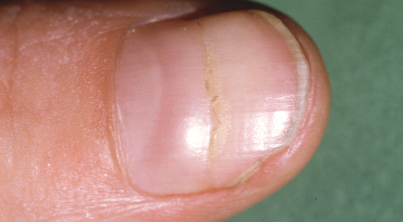 What Do Those Ridges on Your Nails Really Mean? Simple Daily Habits to Support Healthier Nails