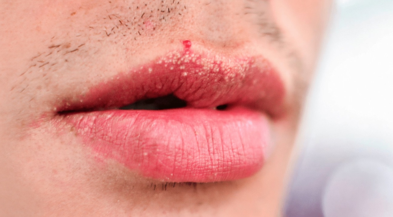 Why Do People Get Unusual White Bumps on Their Lips or Private Parts? A Simple Guide to Understanding