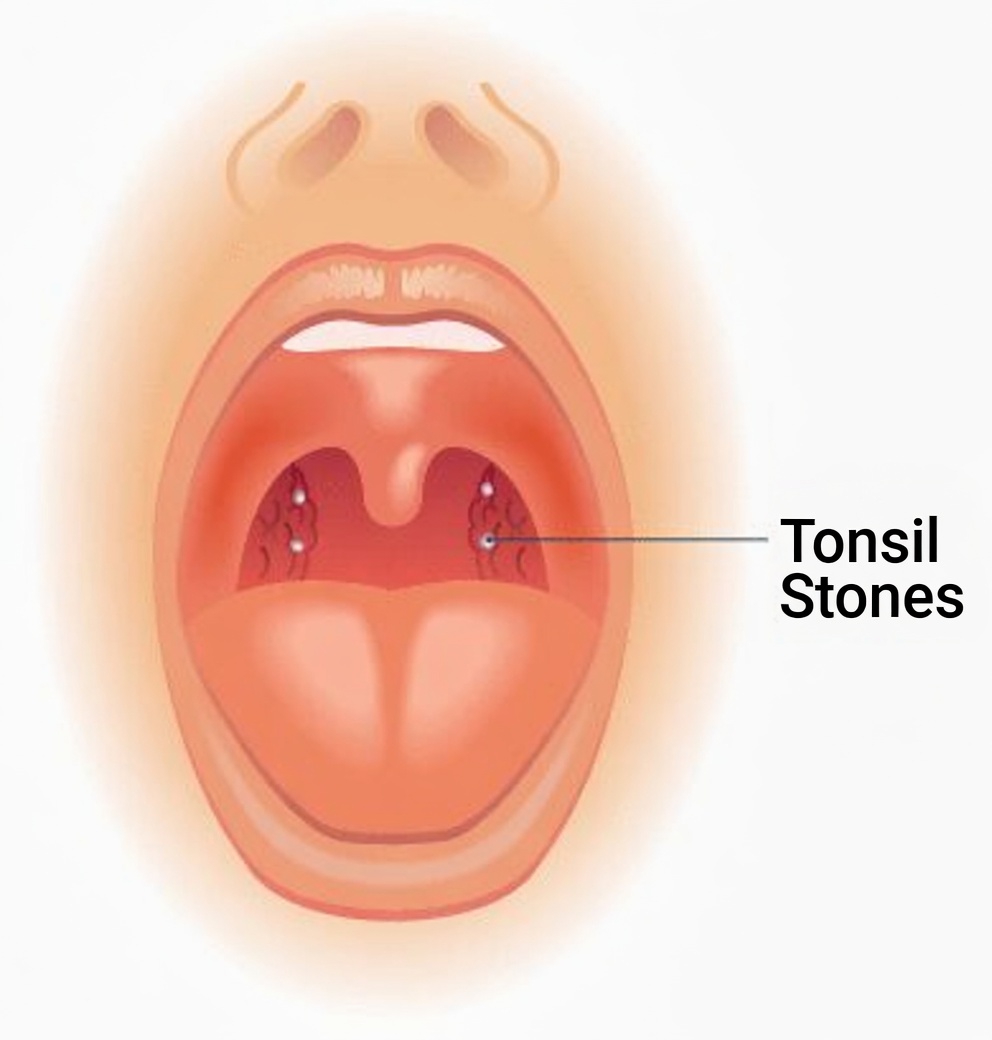 What Is That Weird Lump You Coughed Up After Sneezing? Exploring Tonsil Stones and What They Mean
