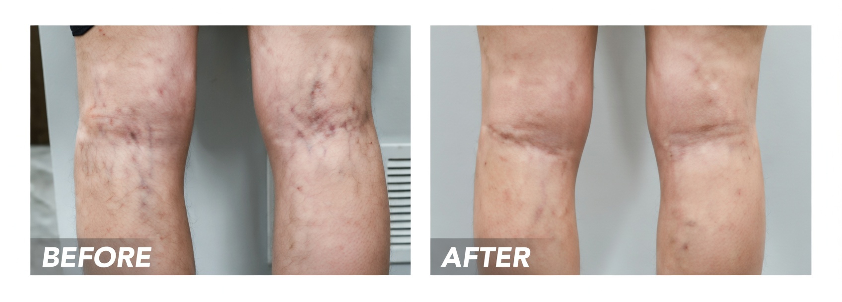 Grandma’s Secret Varicose Vein Remedy: Why Many Over 50 Are Exploring Aloe Vera, Apple Cider Vinegar, and Lemon for Leg Comfort