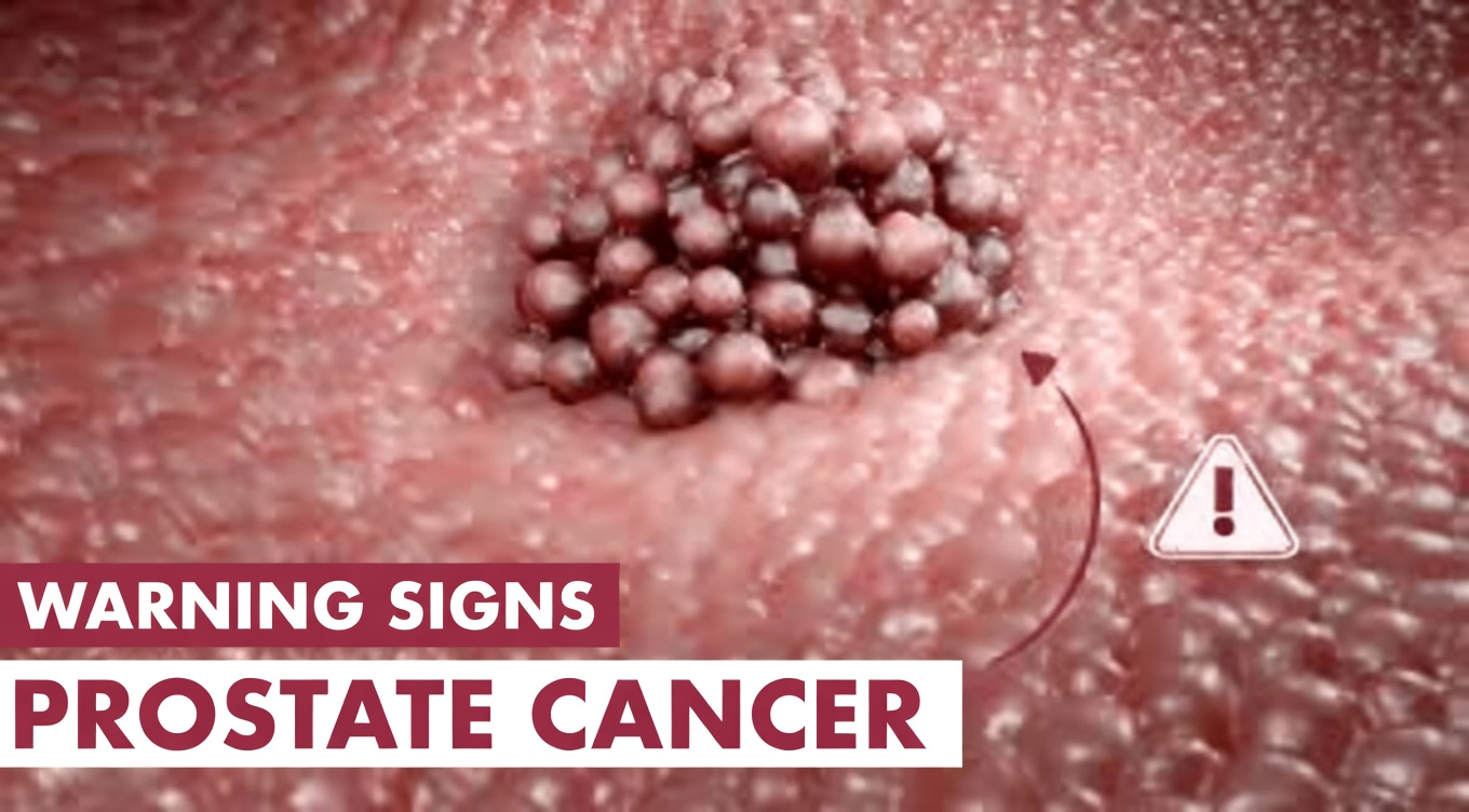 13 Early Silent Signs of Prostate Cancer Symptoms Men Over 50 Should Know About