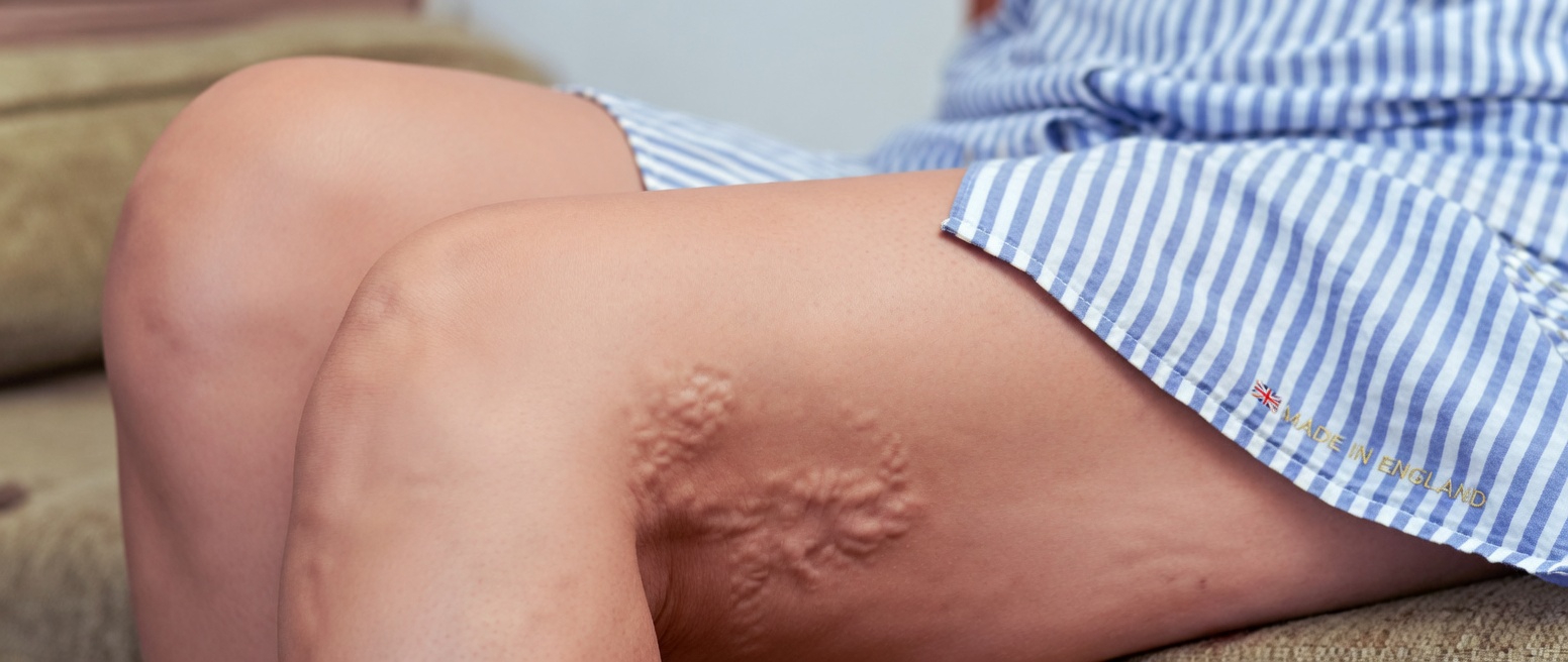 Garlic, Cloves, and Ginger: A Natural Approach to Supporting Circulation and Easing Varicose Vein Discomfort