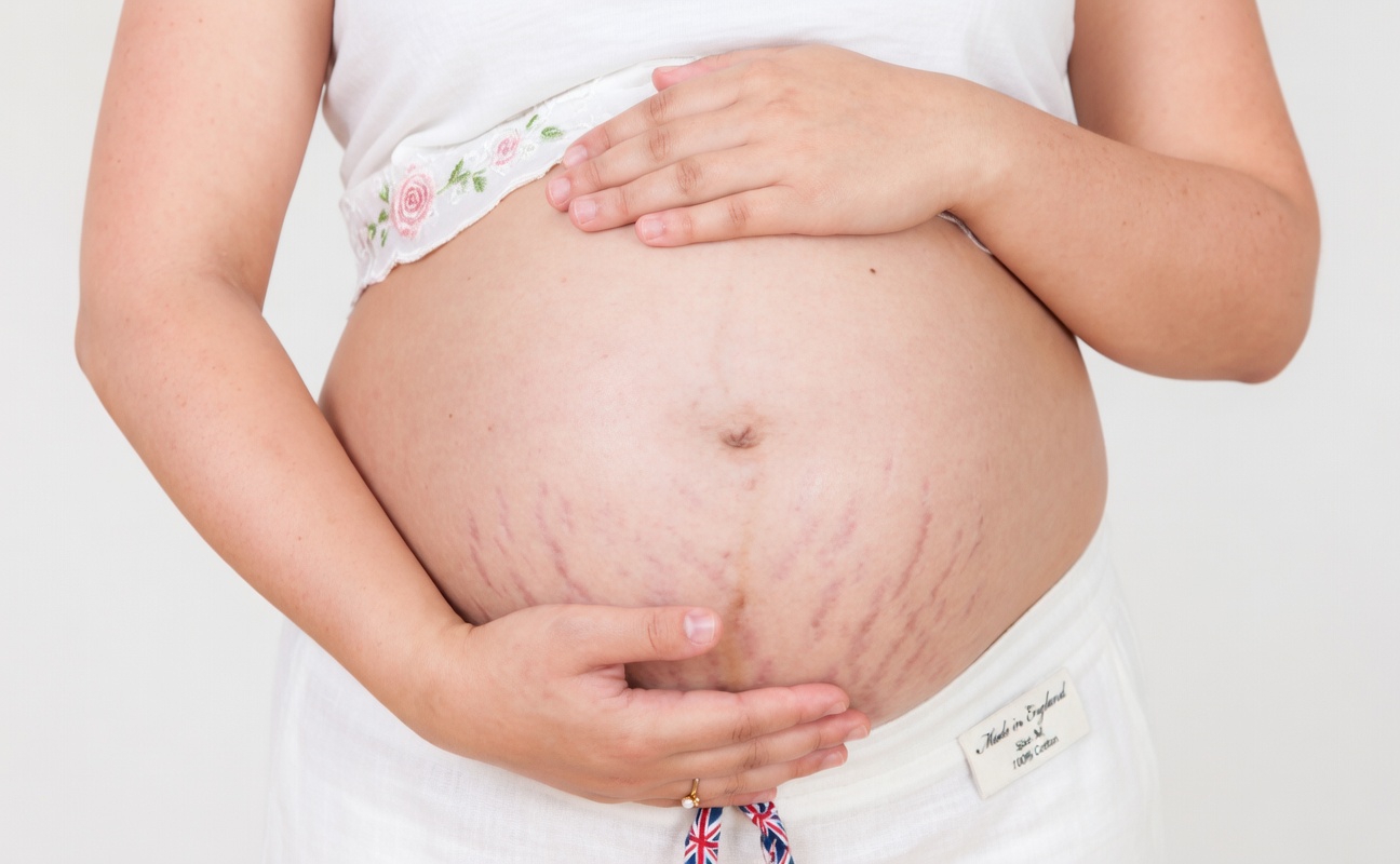 How to Support Your Skin During Pregnancy and Life Changes: Simple Habits That Help Minimize Stretch Mark Appearance