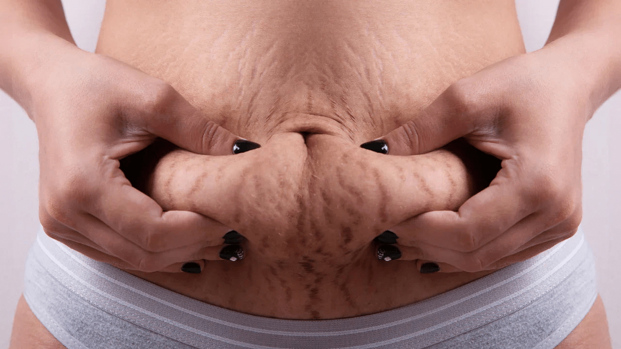 How to Support Your Skin During Pregnancy and Life Changes: Simple Habits That Help Minimize Stretch Mark Appearance