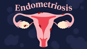 What Every Woman Should Know About Endometriosis: Symptoms, Key Facts, and Practical Daily Tips