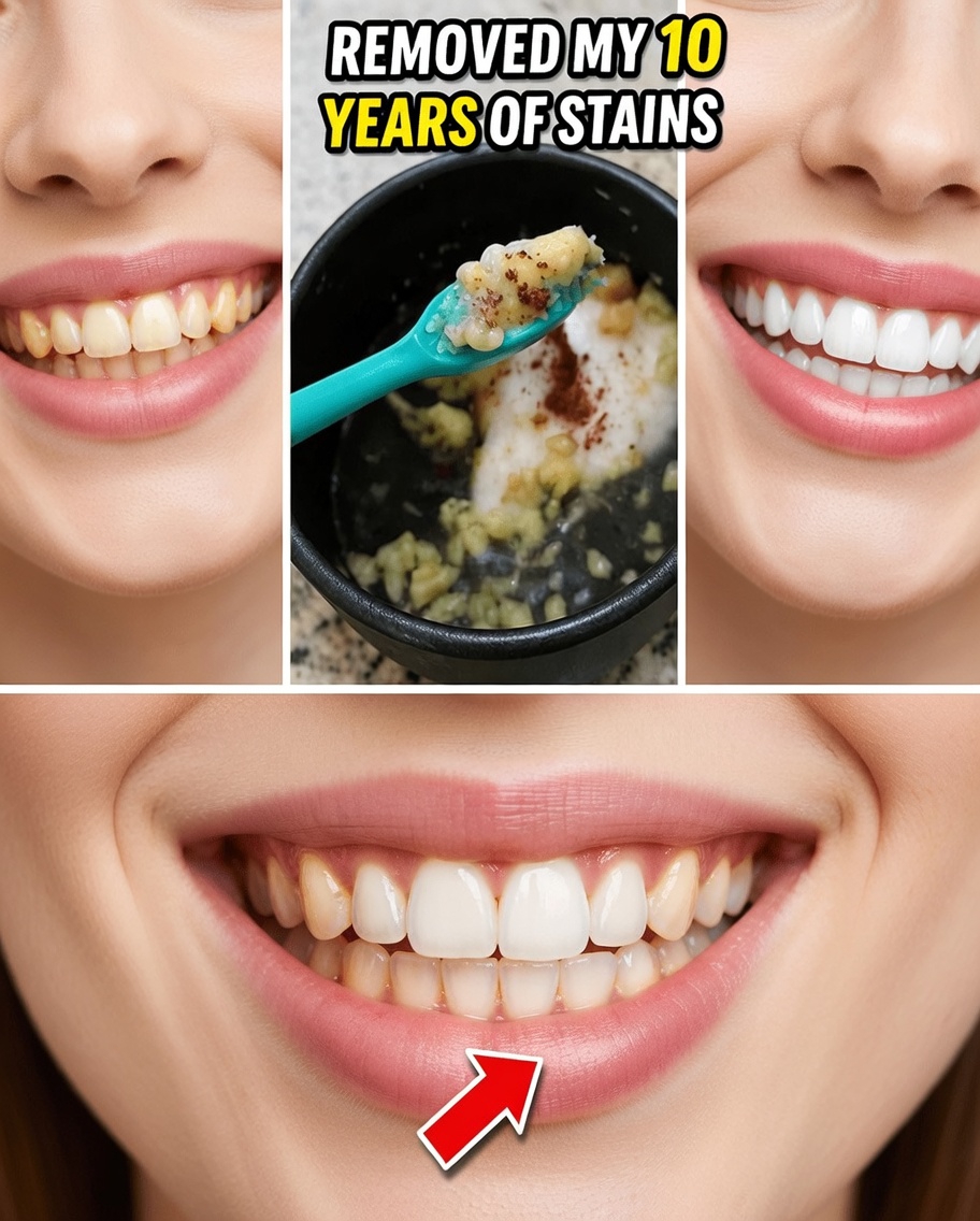 Try This Easy 2-Minute Garlic Teeth Whitening Hack Using Kitchen Ingredients for a Brighter Smile