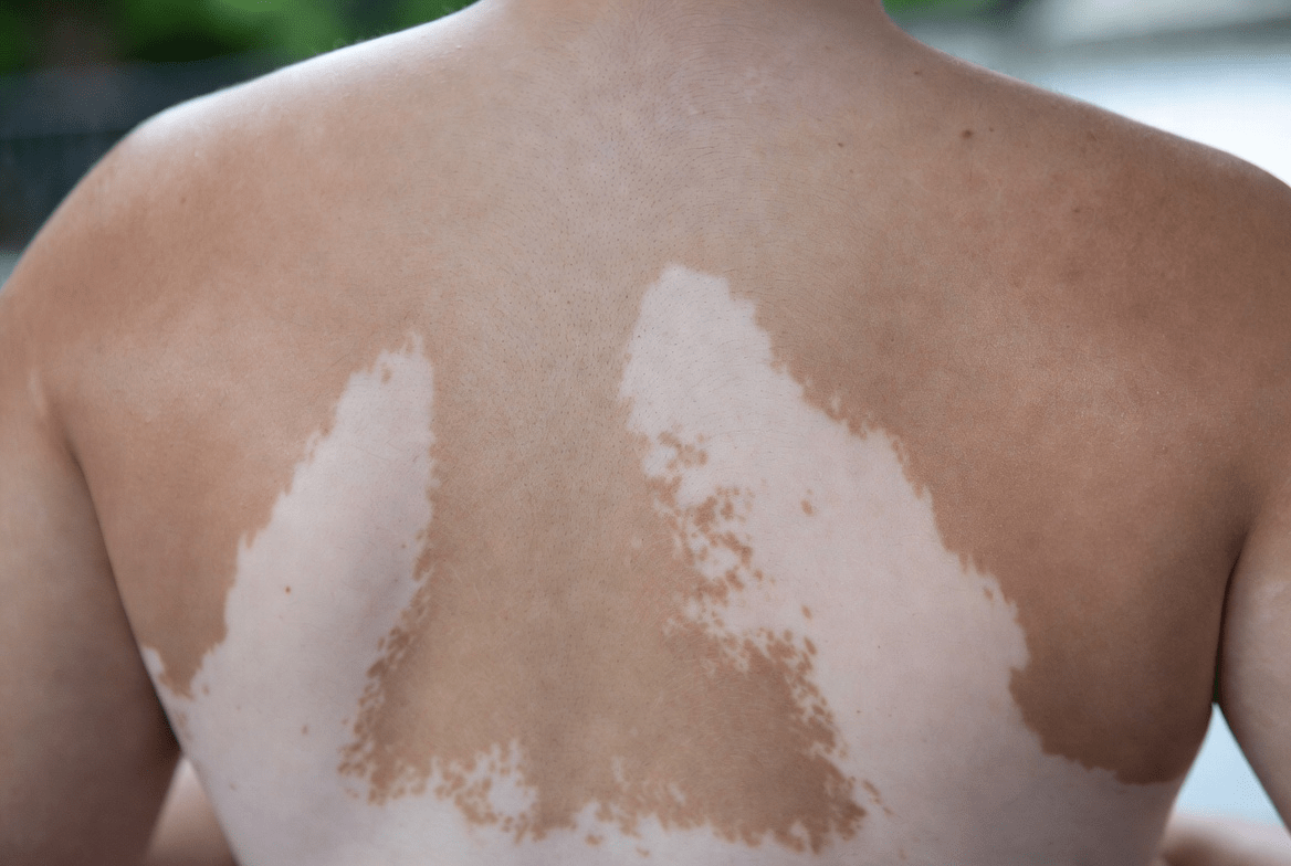 Why White Spots Appear on Your Skin: Common Causes Worth Knowing