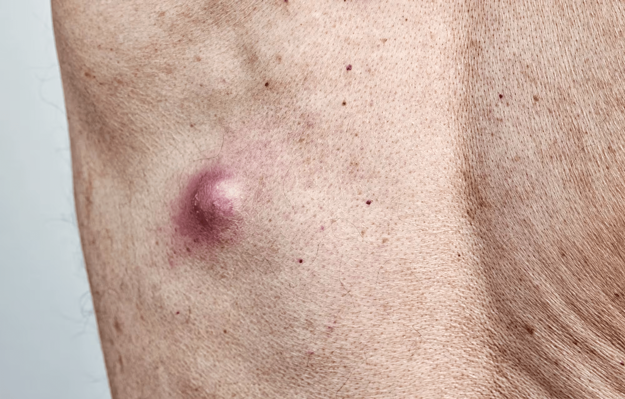 Cyst vs Lump: How to Spot the Difference and Know When It’s Time to Get It Checked