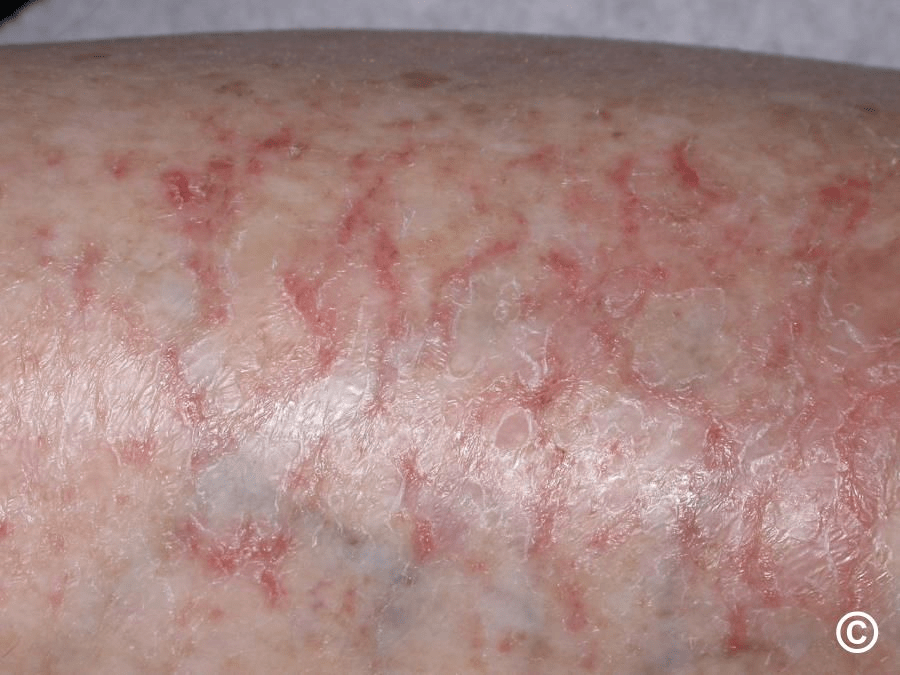 Discover What Your Feet Reveal About Your Liver Health: 12 Common Signs to Watch For