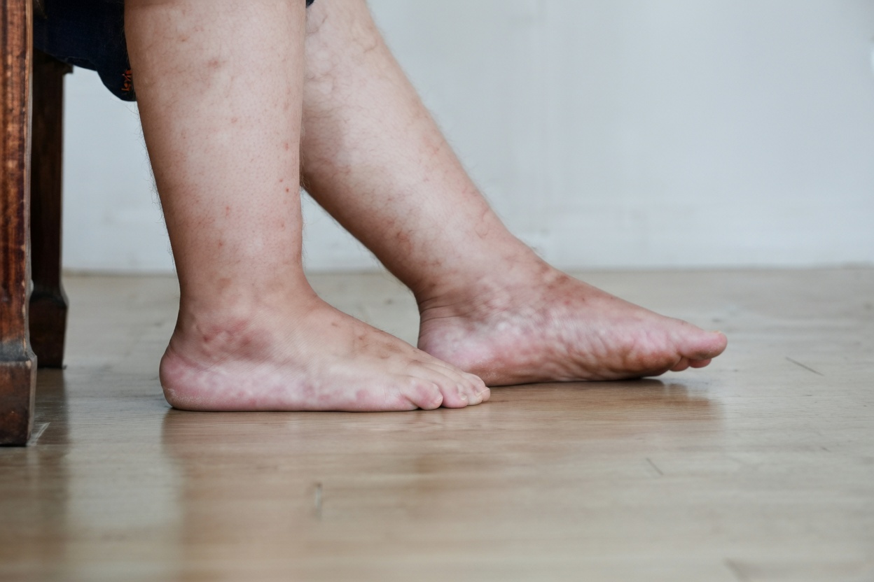 #1 Vitamin to Eliminate Swollen Legs and Ankles