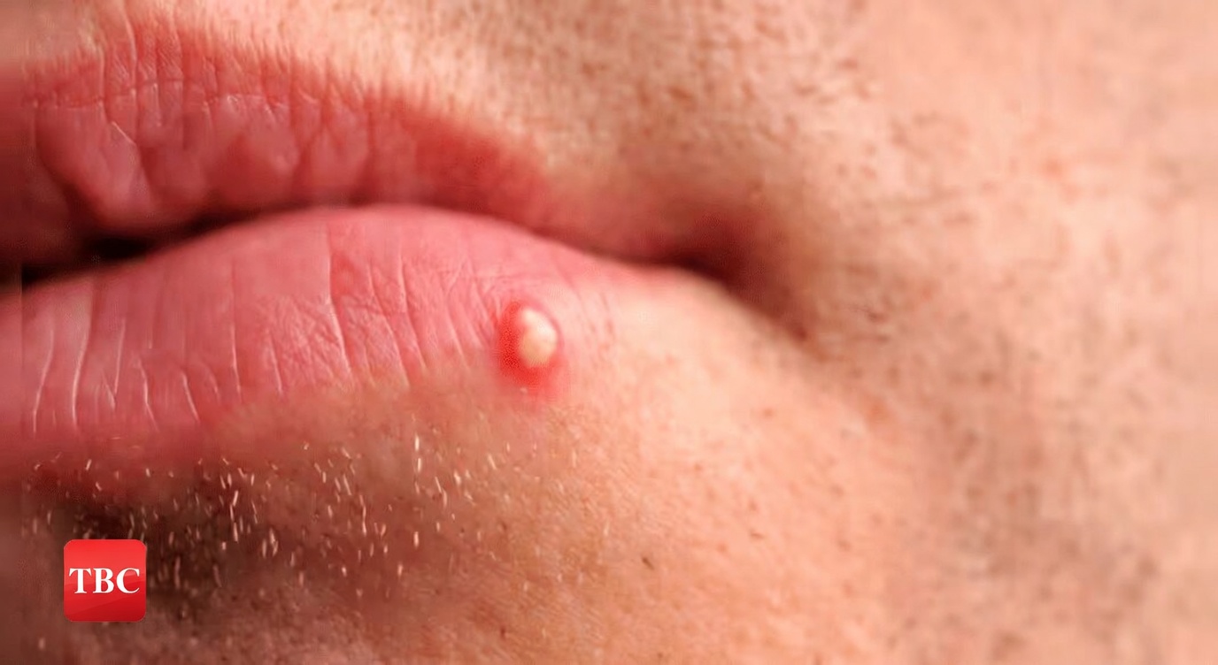 Why You Might Notice Unusual White Bumps on Your Lips or Private Parts and What It Means