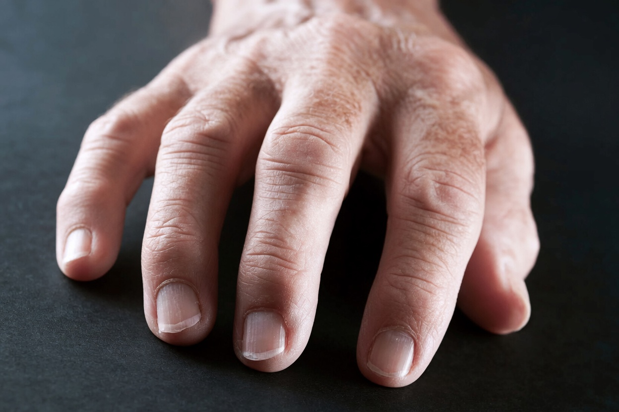 What New Treatment Advances Are Available for Rheumatoid Arthritis Patients Seeking Hope for Better Days Ahead