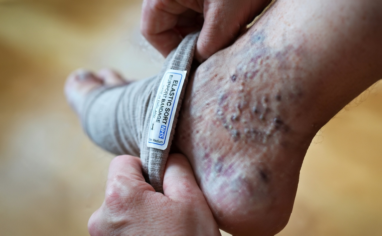 Did You Know That Garlic May Help Naturally Relieve Varicose Vein Discomfort and Reduce Inflammation?