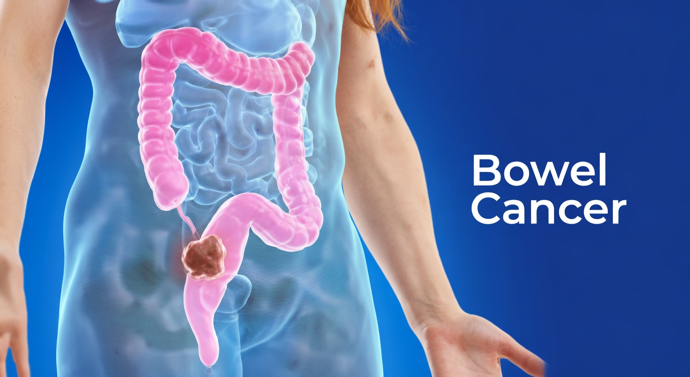 7 Subtle Warning Signs of Colon Cancer You Should Never Ignore and How Awareness Can Empower You