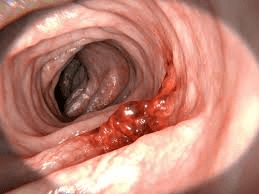 7 Subtle Warning Signs of Colon Cancer You Should Never Ignore and How Awareness Can Empower You