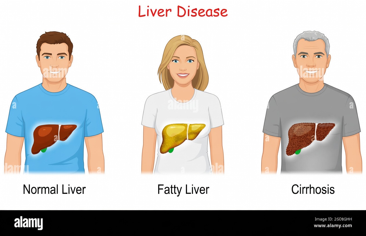 The Silent Threat Hiding in Your Liver: 8 Warning Signs of Fatty Liver Disease to Recognize