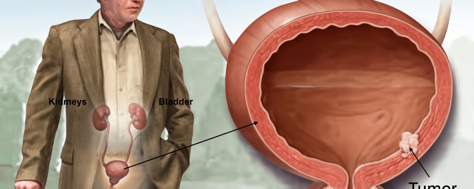 Bladder Cancer Is a Hidden Danger: 10 Warning Signs You Shouldn't Ignore