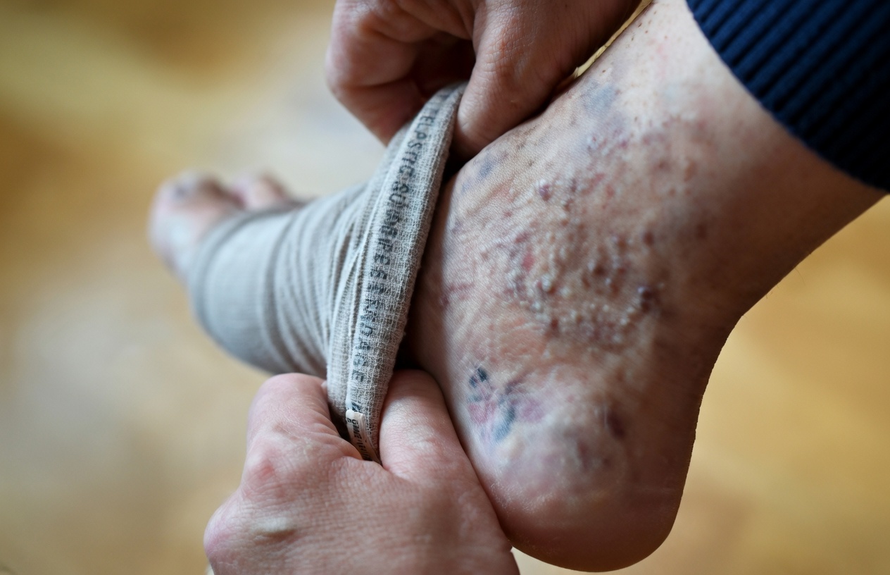 Garlic and Ginger for Varicose Veins: An Effective Natural Remedy