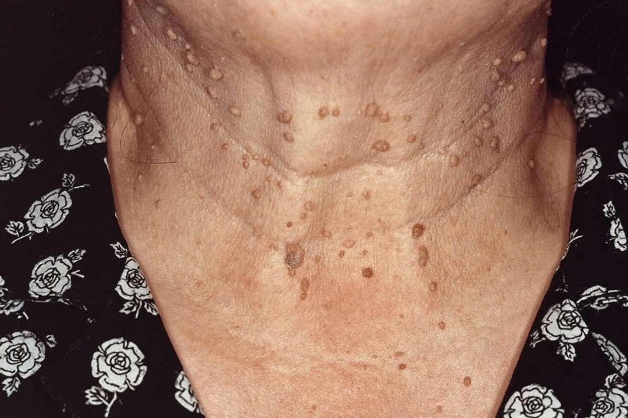 Have You Also Developed These Skin Bumps on Your Neck? Discover Common Reasons and Easy Daily Habits