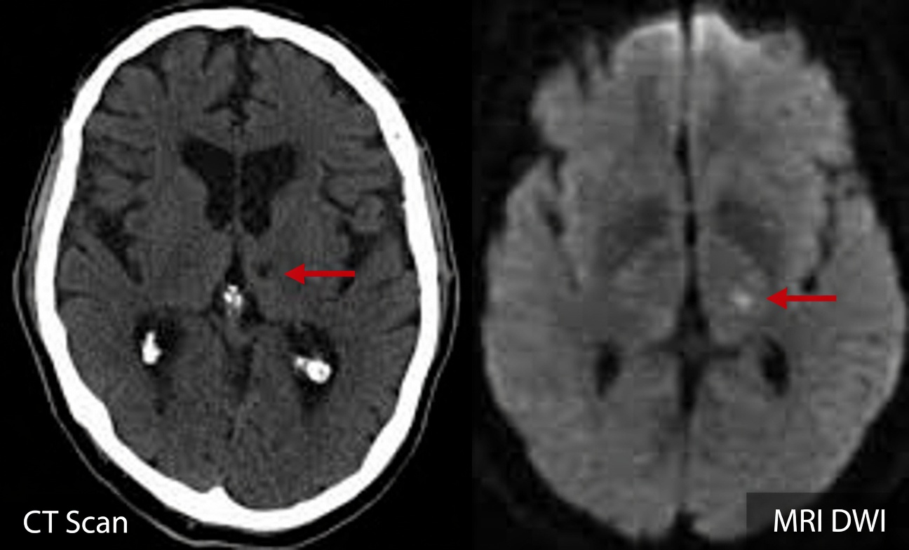 7 Lacunar Stroke Warning Signs in People Over 60 That Everyone Overlooks (Especially #4)