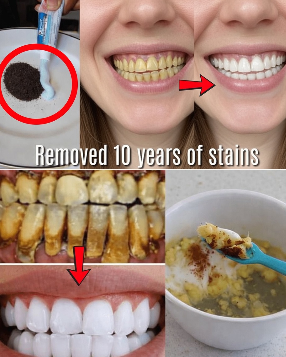 In Just 2 Minutes, Remove 10 Years of Teeth Stains – The Natural Whitener That Actually Works