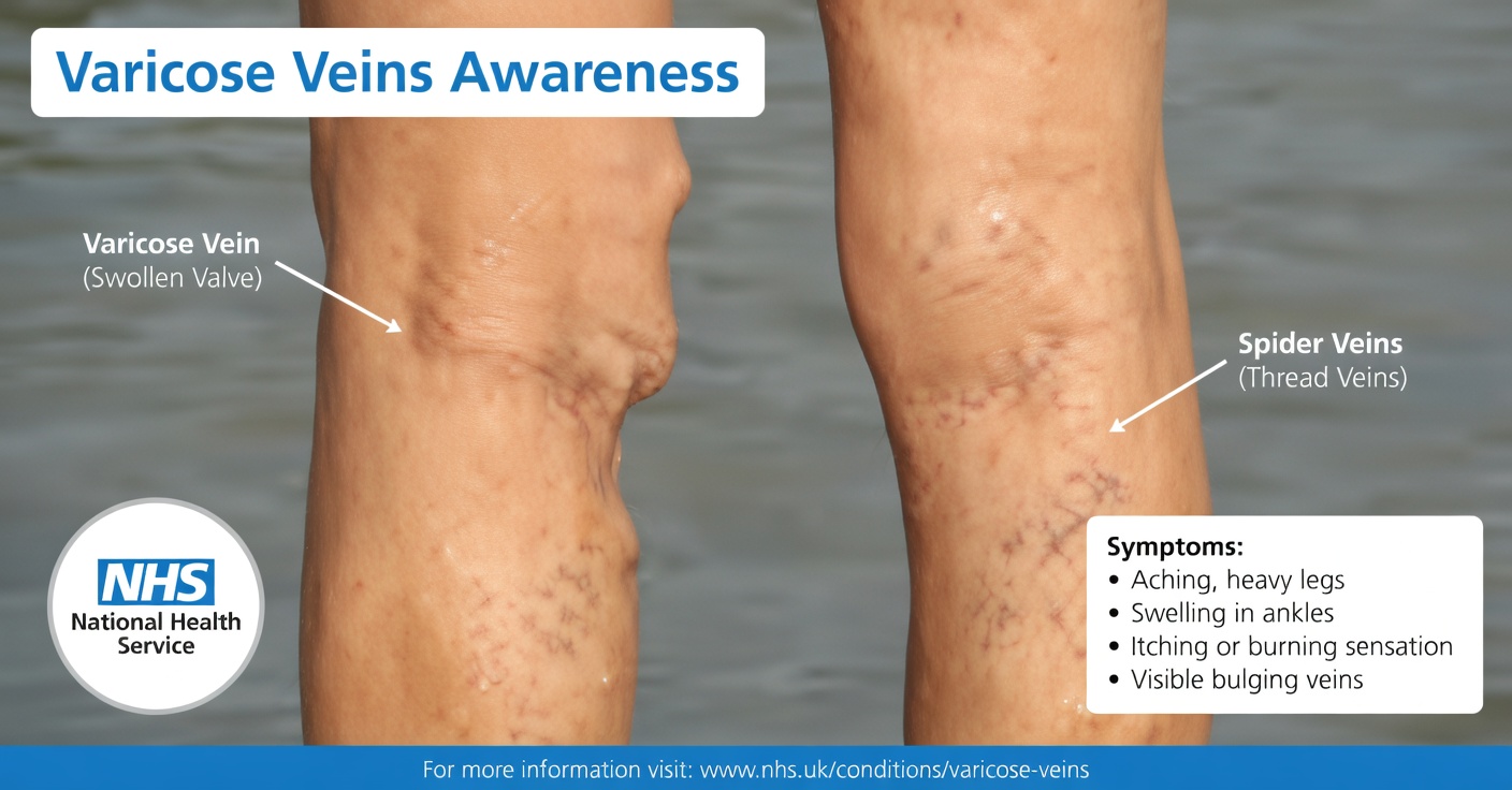 Why Are My Veins Suddenly Bulging and Visible?