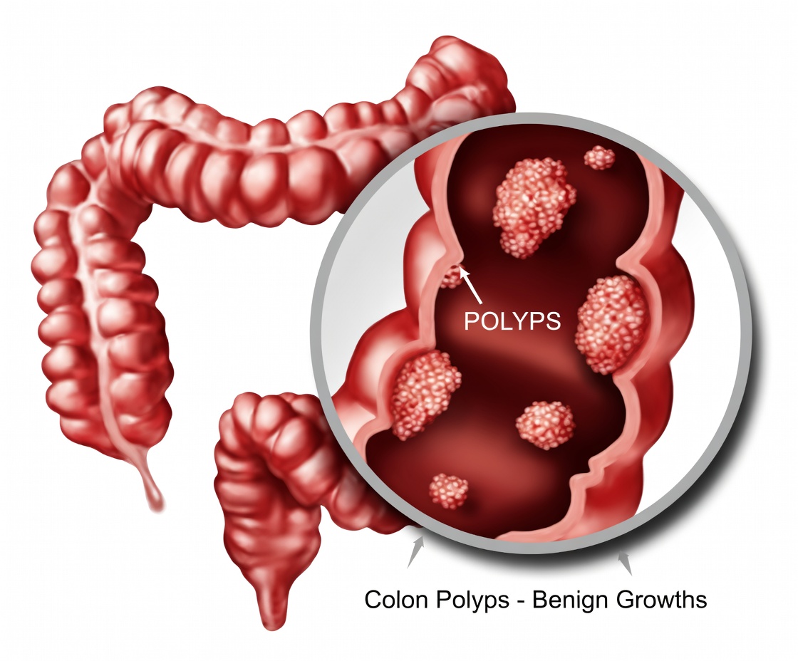 Critical Colon Cancer Symptoms You Should Never Ignore – Early Detection Could Save Your Life