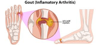 The Easiest and Quickest Ways to Help Eliminate Uric Acid Crystals from Your Body to Prevent Gout and Joint Pain