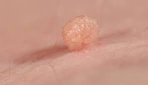 Remove Skin Tags Overnight with Vaseline