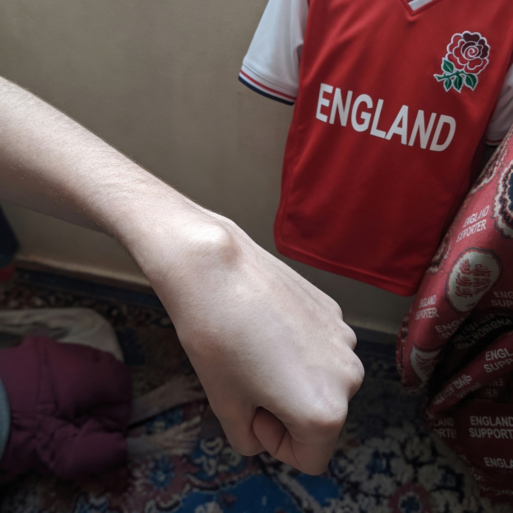 My grandmother developed this strange lump on her wrist overnight. What could this be? I’m worried because it looks abnormal