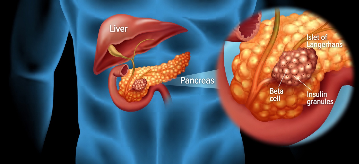 Pancreatic Cancer: Two Symptoms That Came Too Late