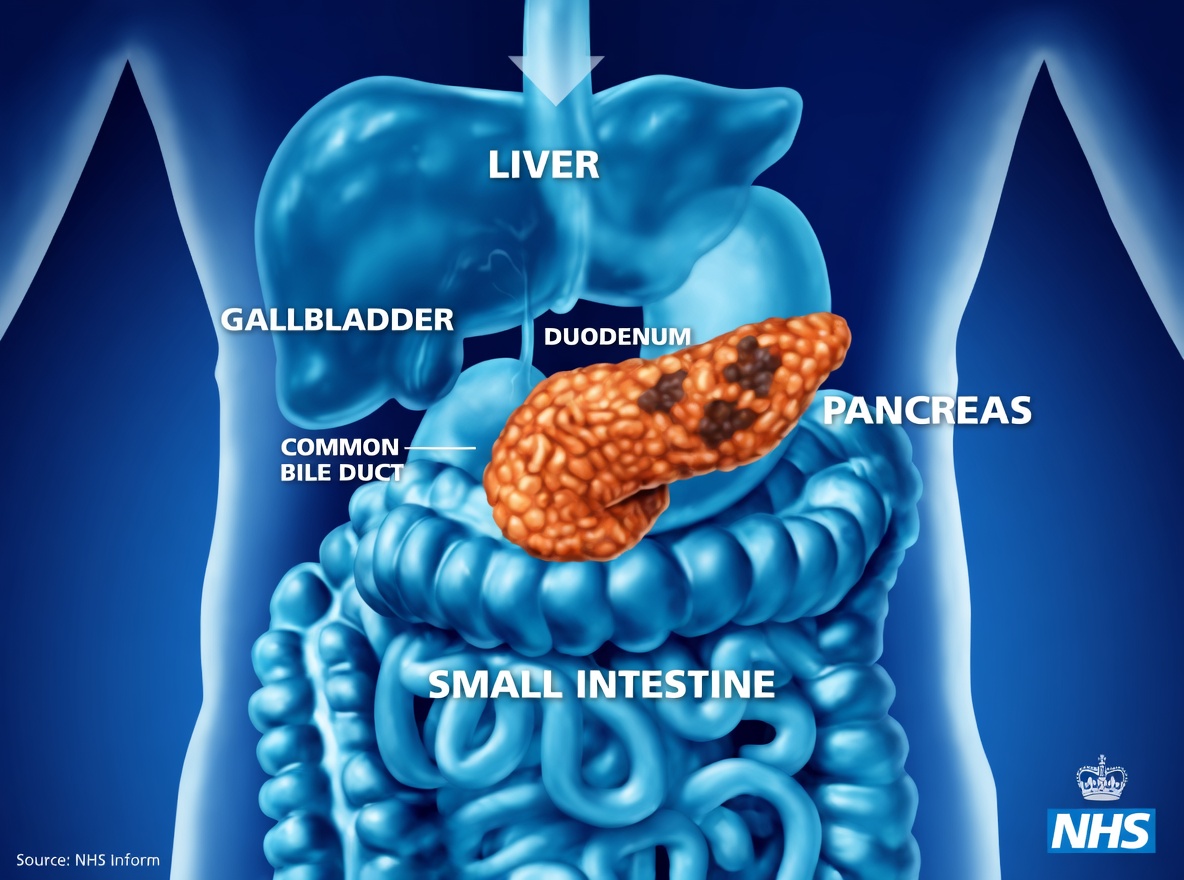 Pancreatic Cancer: Two Symptoms That Came Too Late