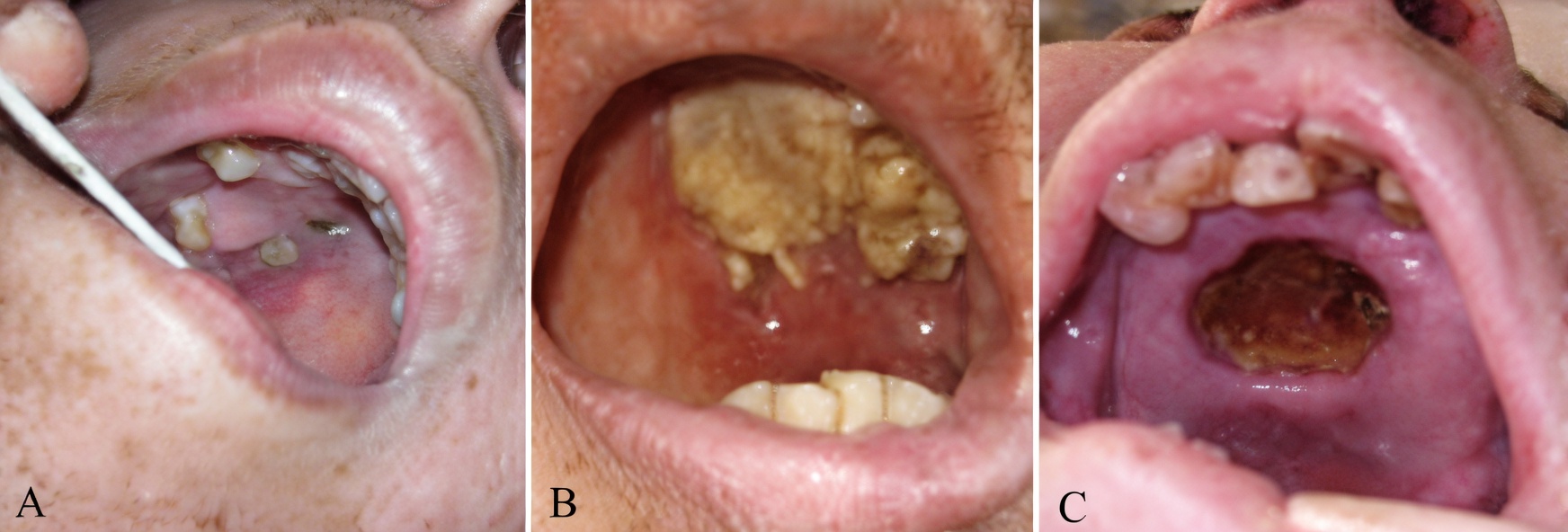 Woman Suffers Nasal Fungal Infection Linked to Everyday Habit